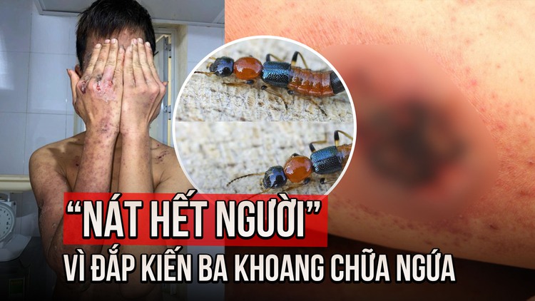 Đắp kiến ba khoang chữa ngứa, nam thanh niên tổn thương da toàn thân