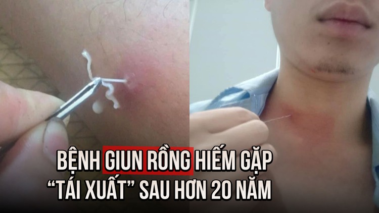 Bệnh giun rồng hiếm gặp 'tái xuất' tại Việt Nam sau hơn 20 năm: Cách để lấy giun khỏi cơ thể an toàn