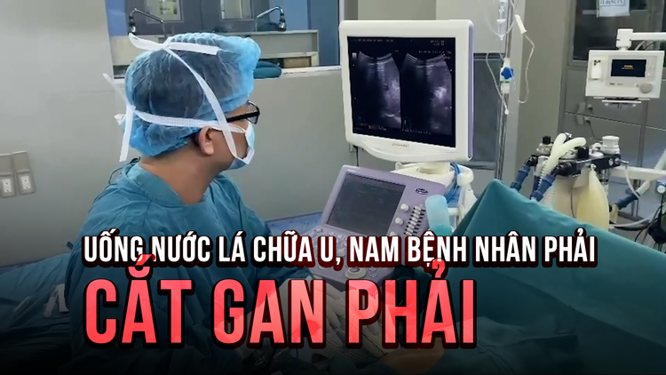 Uống thuốc lá chữa u ở gan, nam bệnh nhân phải cắt toàn bộ gan phải vì u có kích thước 'khổng lồ'