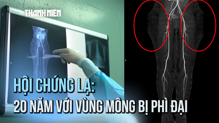 Cô gái trẻ mắc hội chứng lạ: 20 năm sống với vùng mông bị phì đại