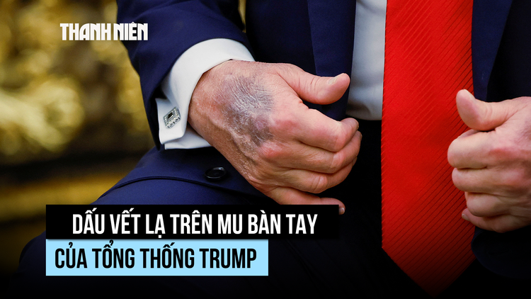 Vết bầm lạ trên mu bàn tay Tổng thống Trump là gì?