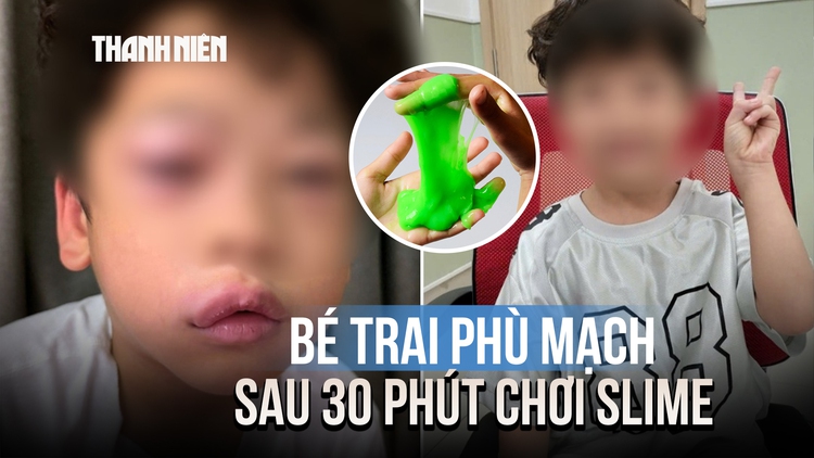Bé trai 5 tuổi phù mạch sau 30 phút chơi 'chất nhờn ma quái' slime