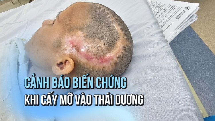 Khuyến cáo cấy mỡ vào thái dương gây biến chứng đột quỵ não
