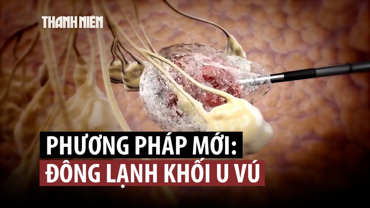 Phương pháp điều trị ung thư vú mới nhiều triển vọng