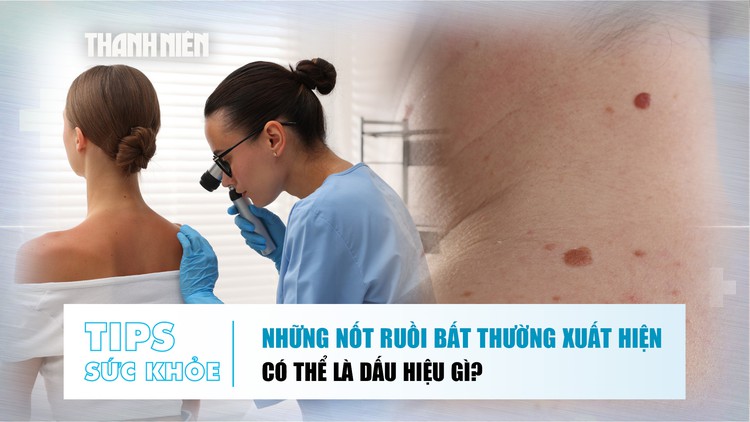 Bản tin sức khỏe 15.7: Nốt ruồi bất thường xuất hiện trên da có thể là dấu hiệu gì?