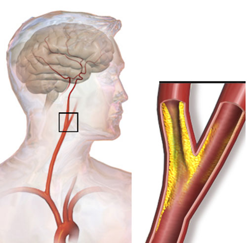 Gốc tự do làm xuất hiện các mảng xơ vữa gây tắc mạch, vỡ mạch khiến não đột quỵ