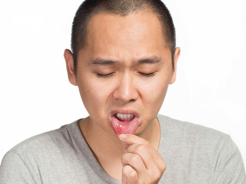 Lở miệng gây ra cảm giác khó chịu - Ảnh: Shutterstock