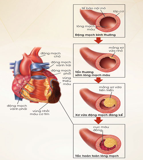 Xơ vữa động mạch có liên quan mật thiết tới tăng huyết áp và bệnh tim mạch