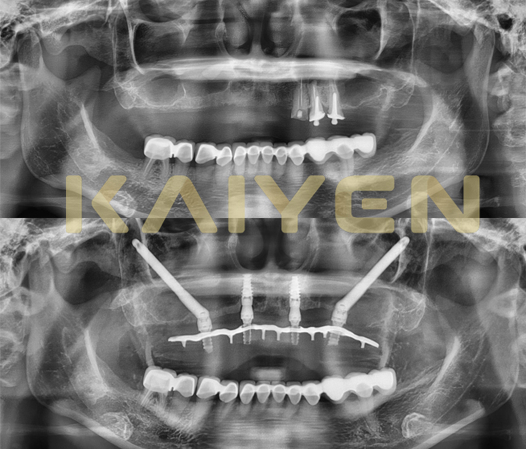 Một trường hợp trồng răng implant All-on-4 hàm trên được bác sĩ Trần Thanh Phong thực hiện, giúp phục hồi chức năng nhai và thẩm mỹ cho bệnh nhân