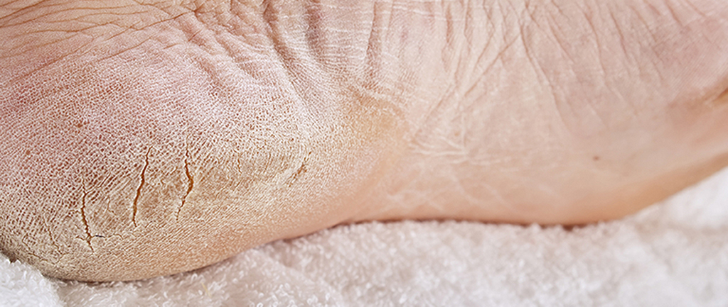 Vùng da chân thường rất dễ gặp phải tình trạng khô ráp sần sùi