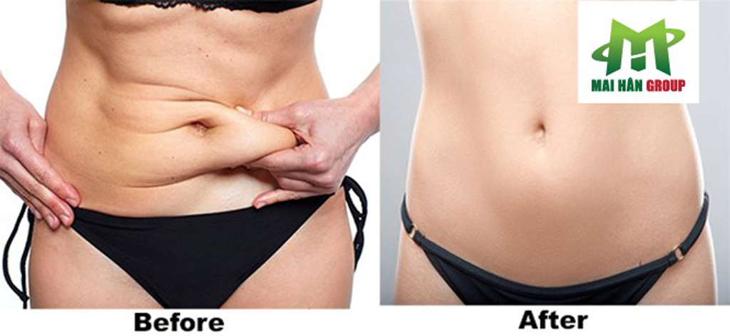 Hình ảnh trước và sau quá trình giảm béo