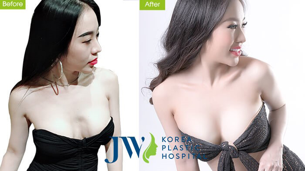 DJ Nhung Babie lấy lại vóc dáng quyến rũ sau khi tái phẫu thuật ngực