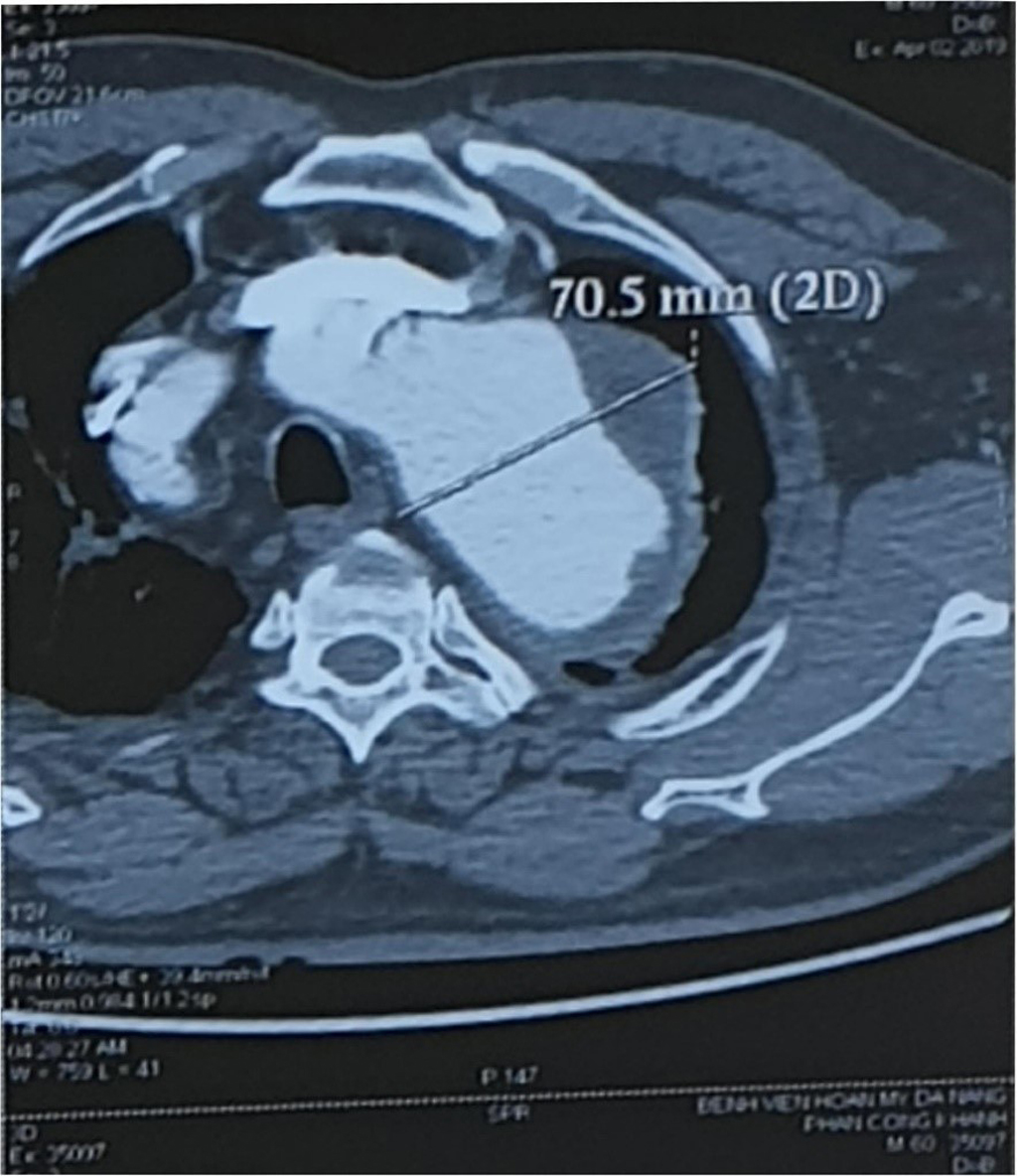 Hình ảnh chụp CT cho thấy kích thước phần quai ĐMC ngực bị phình 
