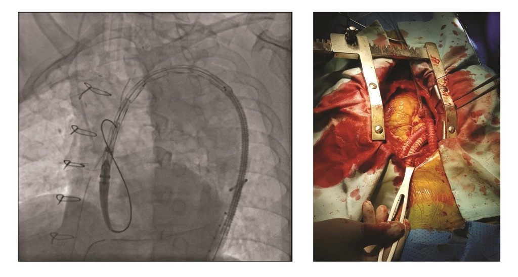 Hình ảnh stent được đặt vào vùng ngực người bệnh - Ảnh: Phú Thành