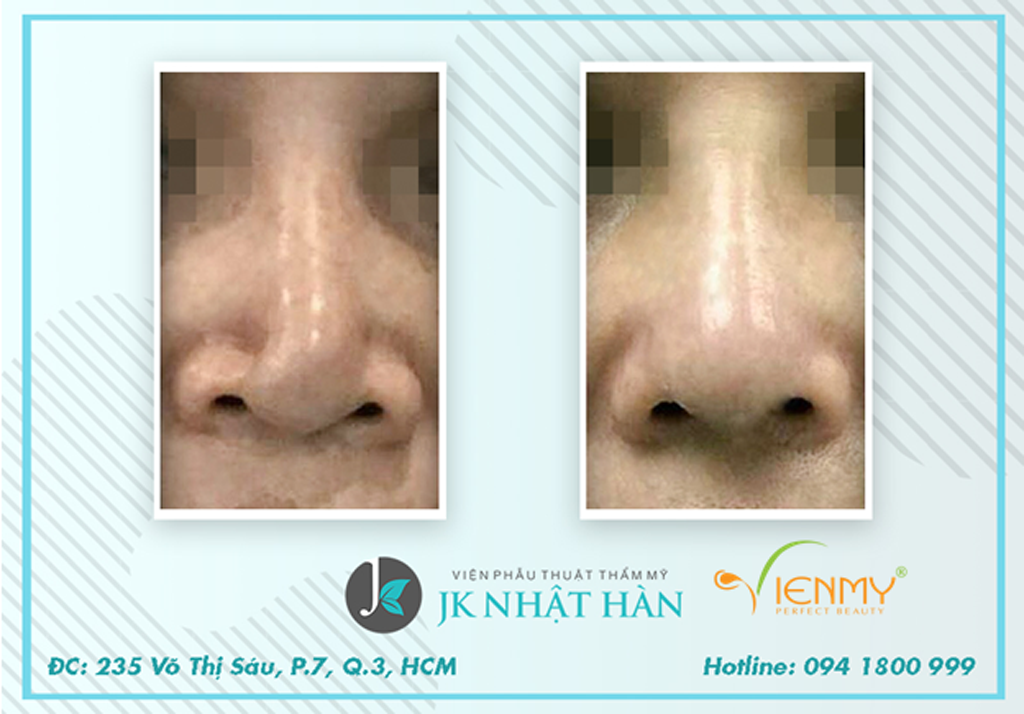 Mũi lệch sống, vẹo đầu mũi sau nhiều năm nâng mũi được tái phẫu thuật