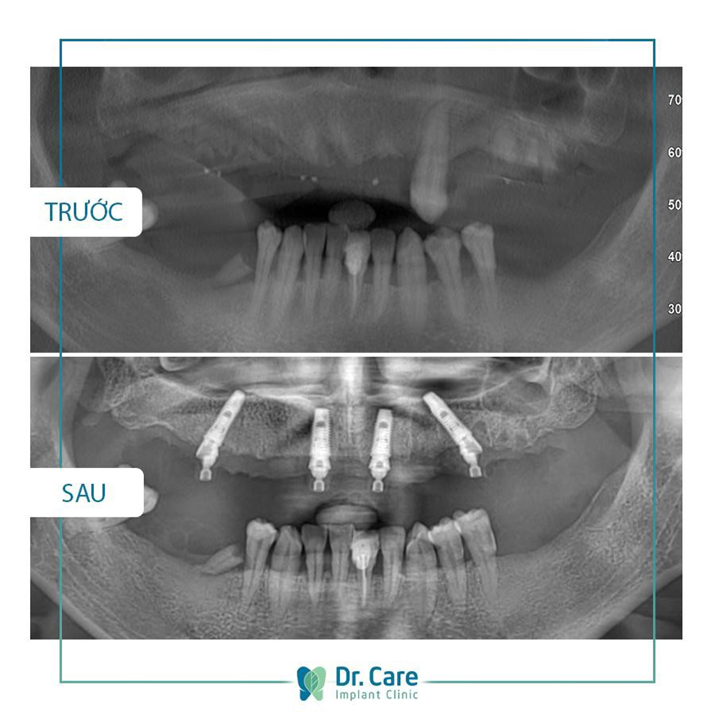  Hình ảnh trước và sau khi trồng răng Implant của chị Thủy