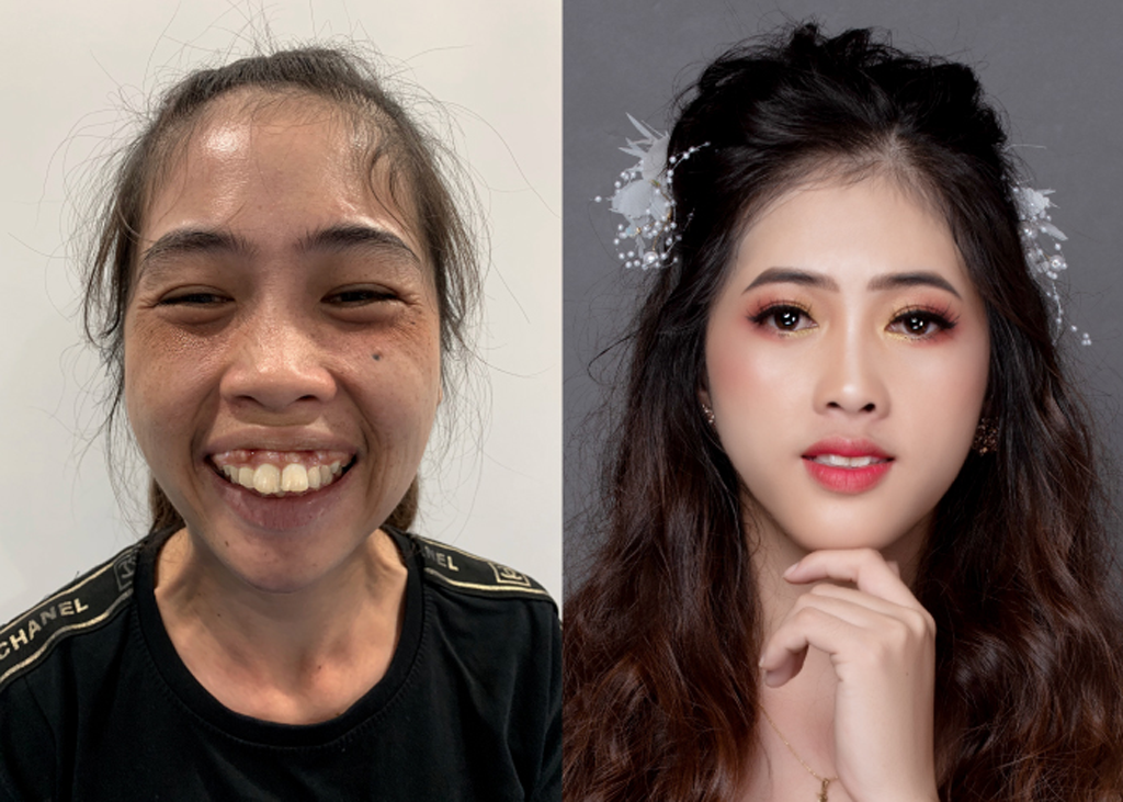 Nhờ được phẫu thuật hàm hô miễn phí, Mỹ Thuận xinh không khác gì hot girl