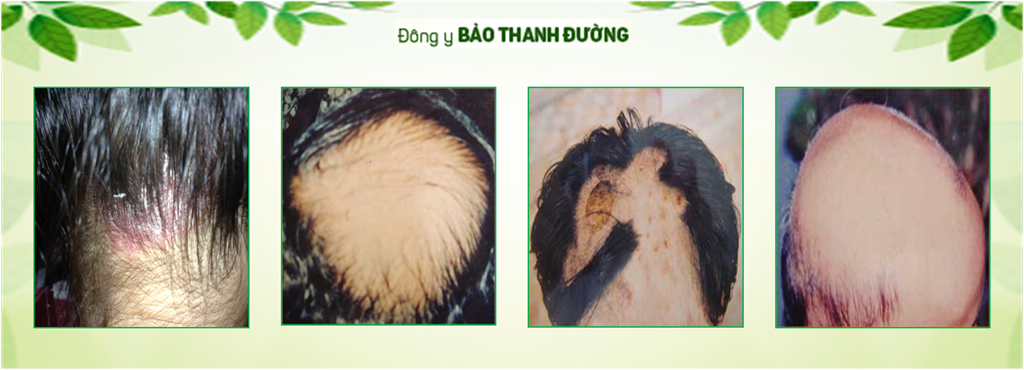 Bảo Thanh Đường có thể chữa các bệnh vẩy nến á sừng có nguy cơ rụng tóc 