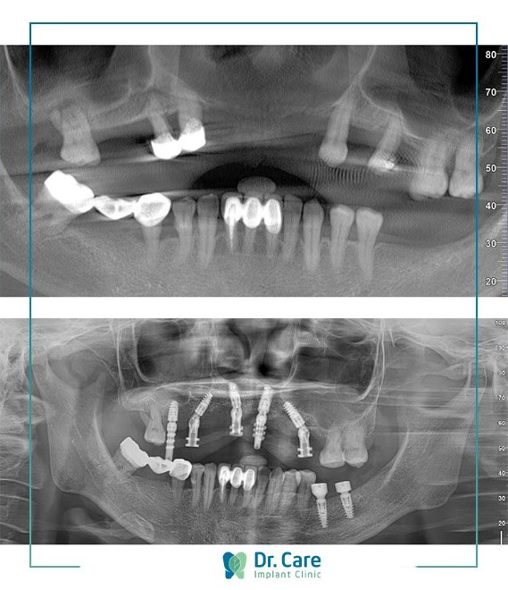 Hình ảnh trước và sau khi trồng răng Implant của cô Kim Lang