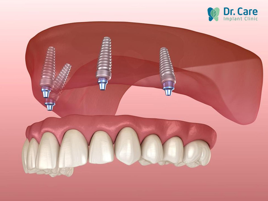 Phương pháp trồng răng Implant All-on- 4 giúp lấy lại khả năng ăn nhai và thẩm mỹ cho người mất răng toàn hàm