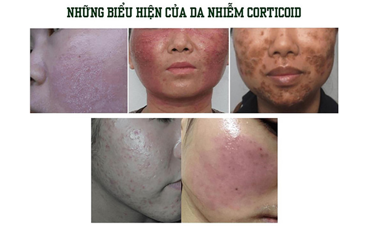 Kem trộn chứa corticoid dần sẽ gây nguy hại cho làn da của bạn