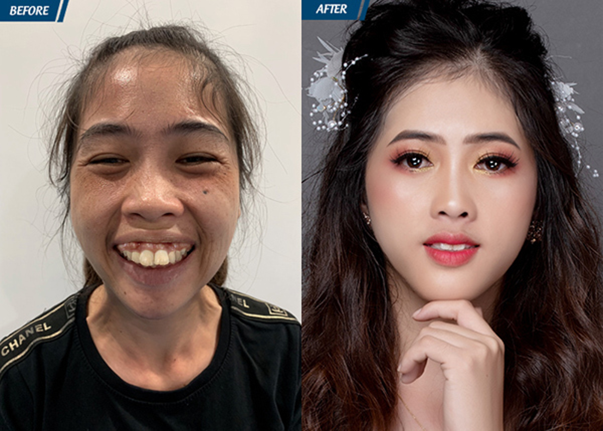  Gương mặt xinh đẹp của Mỹ Thuận sau khi phẫu thuật hàm hô thành công