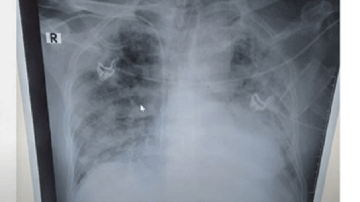 Hình ảnh tổn thương phổi diễn biến nhanh trên bệnh nhân Covid-19 