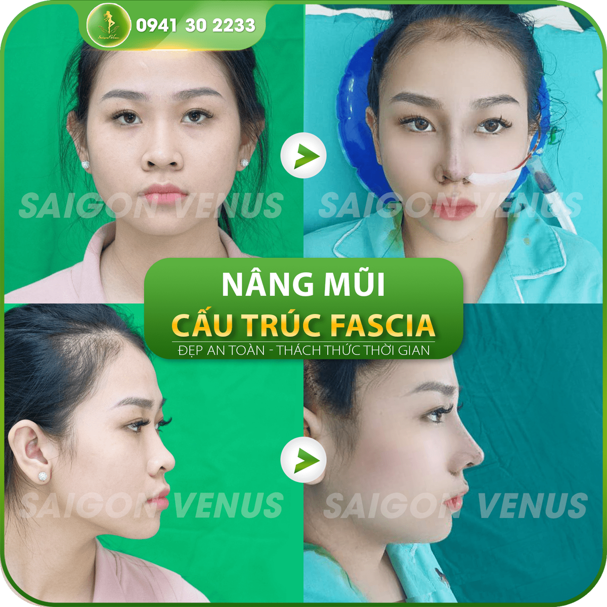 Khách hàng không cảm thấy bất kỳ đau đớn nào sau khi nâng mũi tại Thẩm mỹ viện Saigon Venus - Thạc sĩ, bác sĩ Nguyễn Tiến Huy