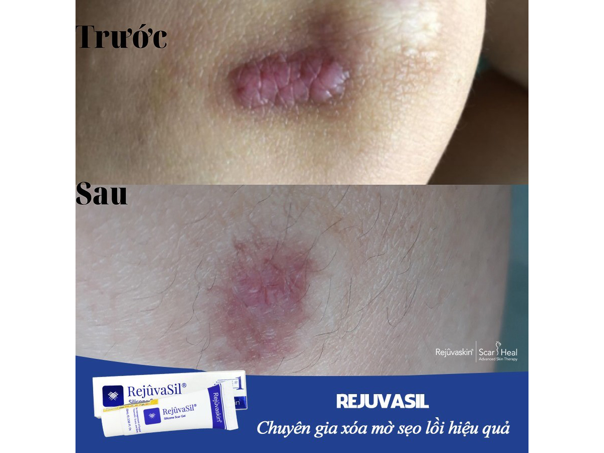 Hiệu quả của khách hàng gửi về sau khi sử dụng gel trị sẹo lồi lâu năm Scar Rejuvasil