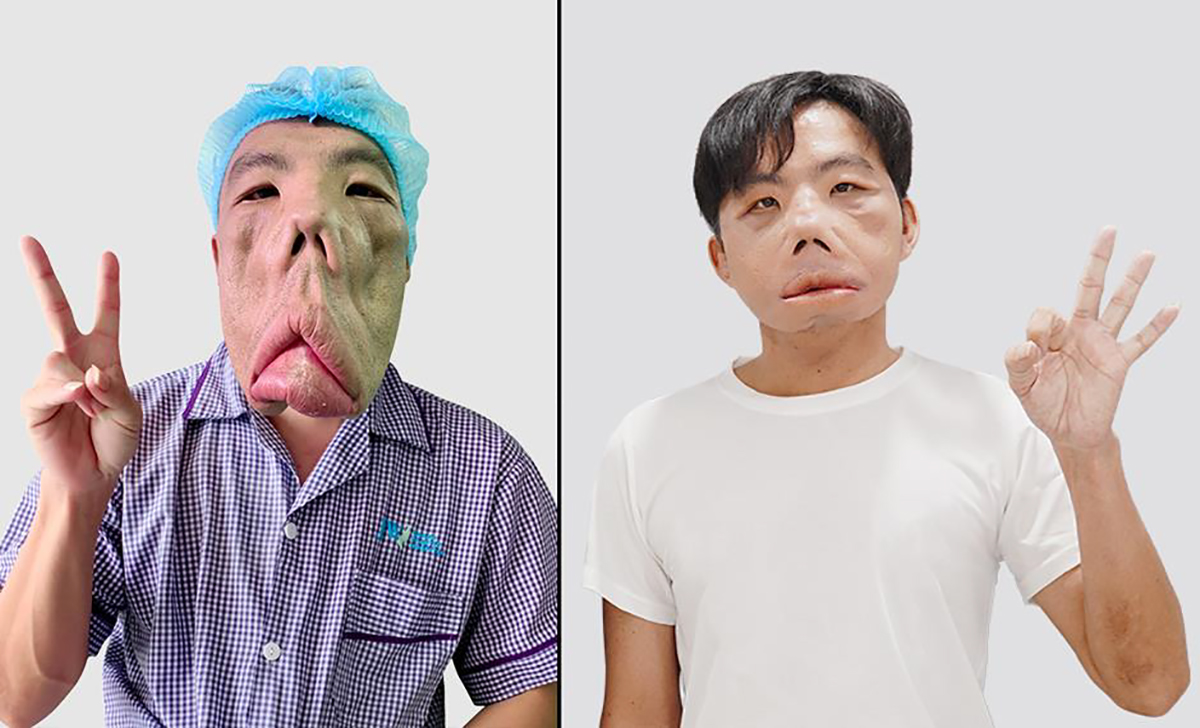 Anh Mến và gương mặt thay đổi ngoạn mục sau 8 tháng điều trị bởi Bác sĩ Tú Dung