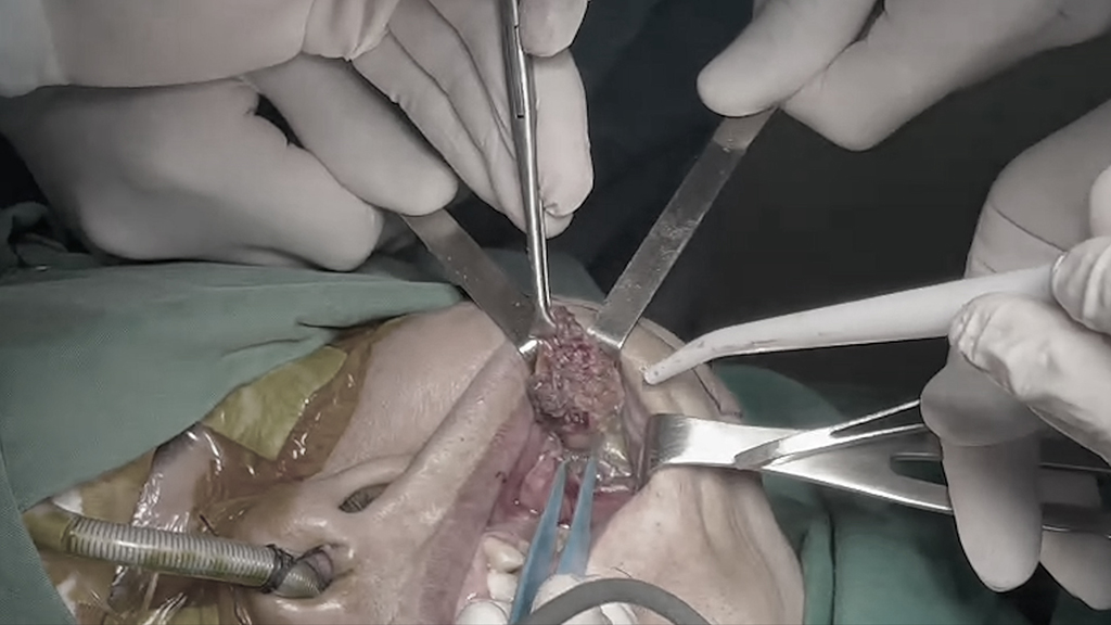Bác sĩ Tú Dung và  ê kíp Bệnh viện JW tỉ mỉ cắt bỏ khối u khỏi niêm mạc bệnh nhân gây biến dạng gương mặt