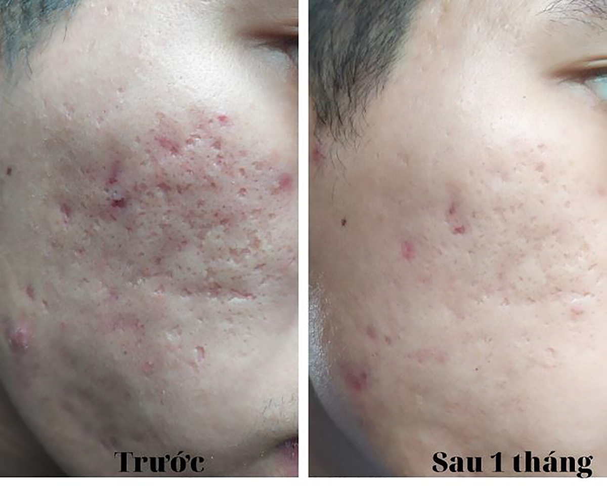 Hình ảnh trước và sau 1 tháng sử dụng kem Scar Esthetique