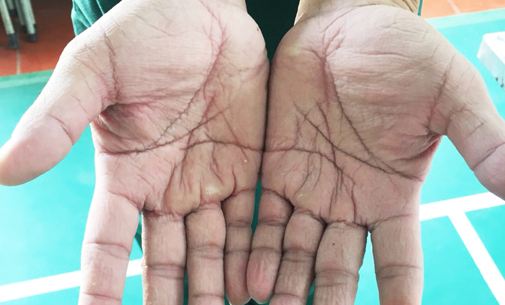 Đôi bàn tay các y bác sĩ nhăn nheo khi phải đeo găng tay làm việc cả ngày, mồ hôi không có chỗ thoát