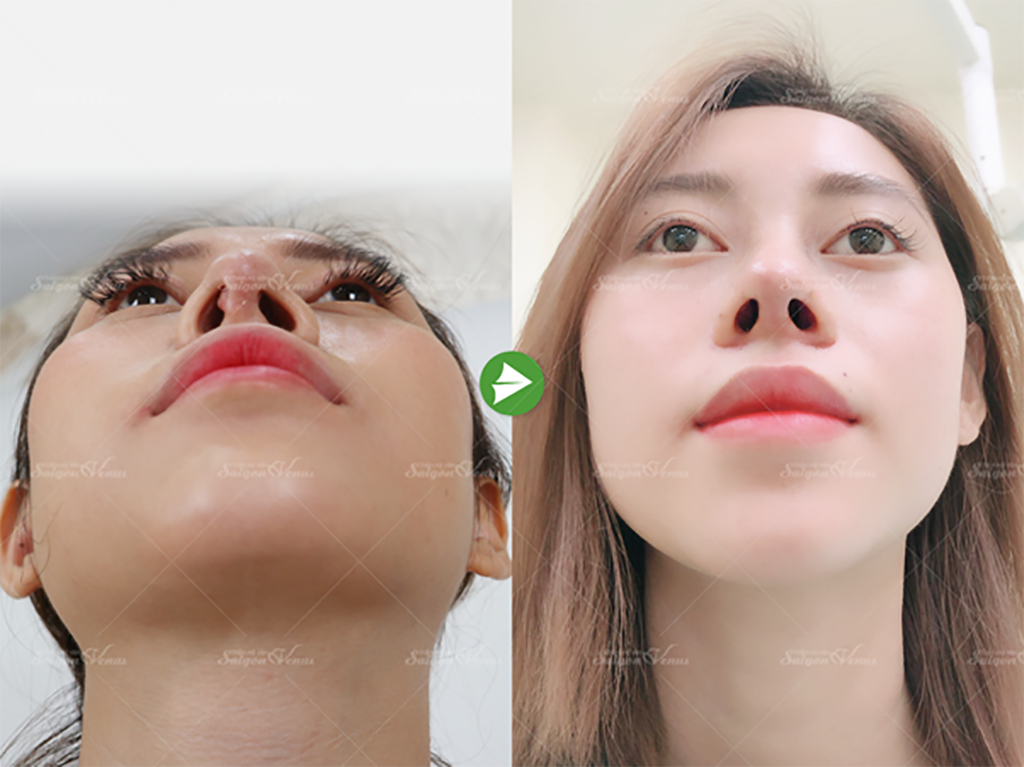 So sánh trước và sau tái phẫu thuật nâng mũi của Phương Thoa