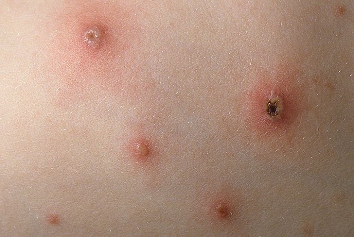 Triệu chứng của bệnh thủy đậu trên da