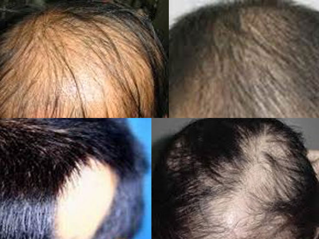 Nhiều trường hợp bệnh rụng tóc được Bảo Thanh Đường chữa dứt và cho sức khỏe tốt lên.