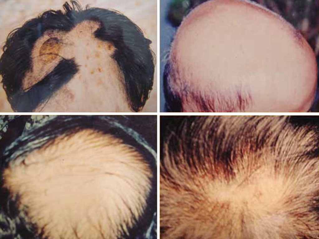 Nhiều trường hợp bệnh rụng tóc được Bảo Thanh Đường chữa dứt hẳn 