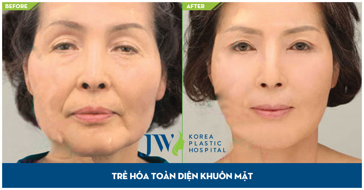 Hình ảnh áp dụng cấy mỡ mặt, trẻ hóa toàn diện khuôn mặt tại JW