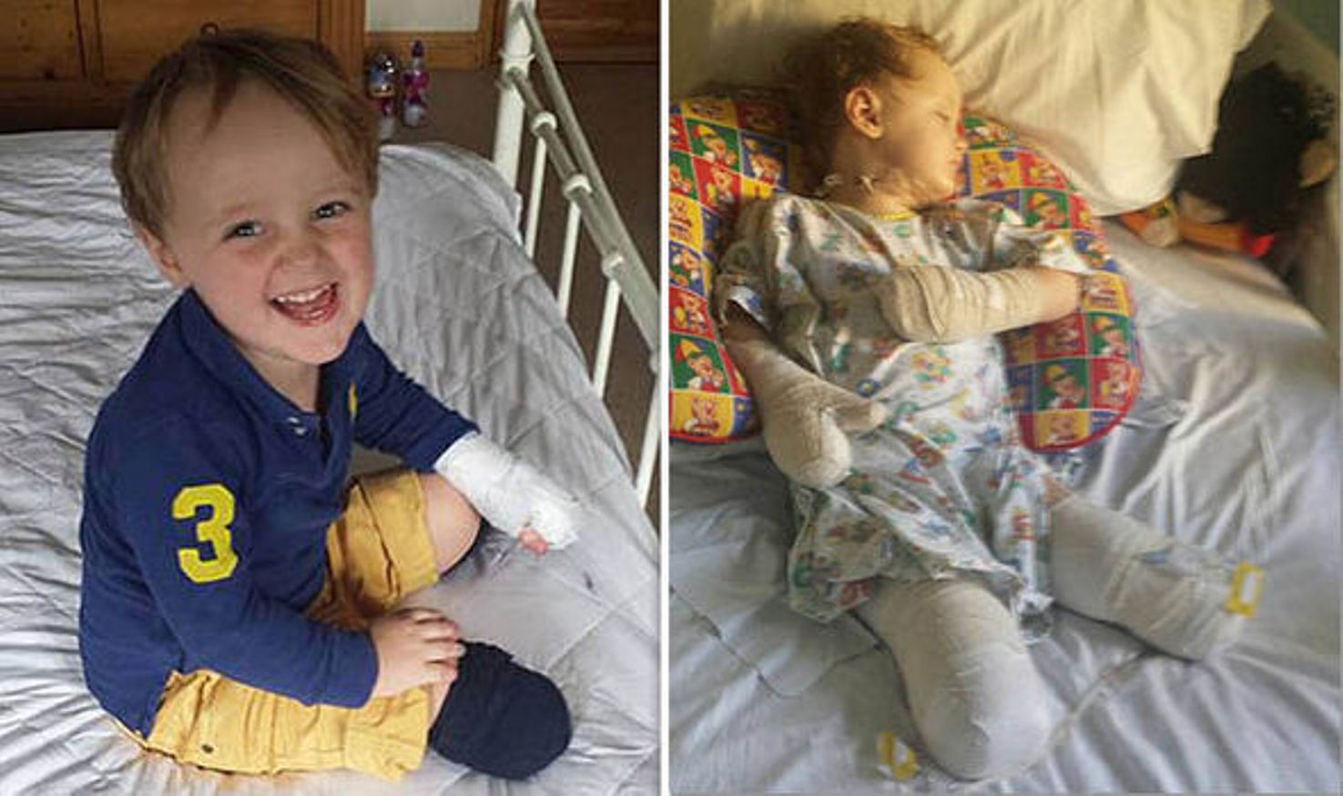 Bé trai 3 tuổi bị cưa hai chân do bác sĩ chẩn đoán sai