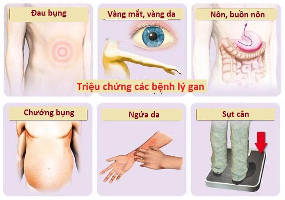 VN đứng thứ ba thế giới về số mắc ung thư gan