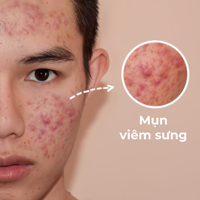 Mụn Viêm Sưng Đỏ: Nguyên Nhân, Dấu Hiệu và Cách Điều Trị Hiệu Quả