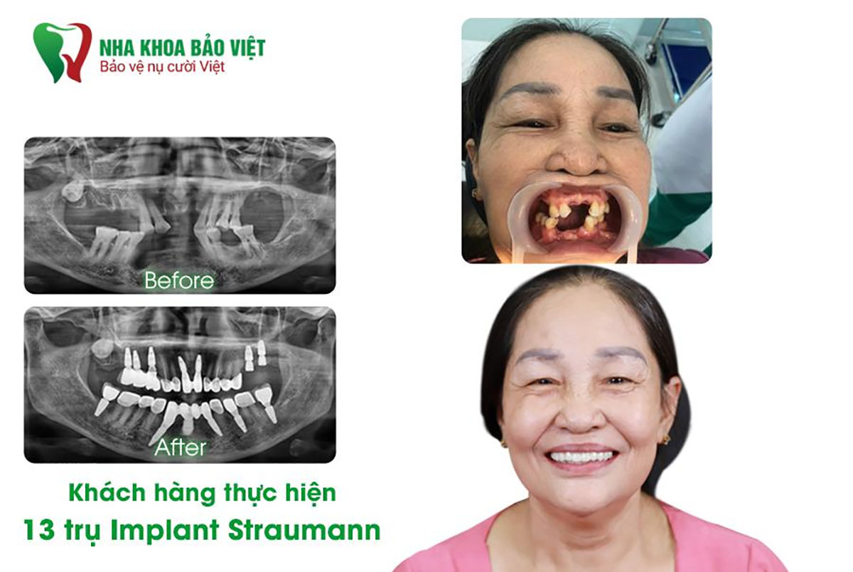 Khách hàng phục hình răng thẩm mỹ với 13 trụ Implant Straumann tại Nha khoa Bảo Việt