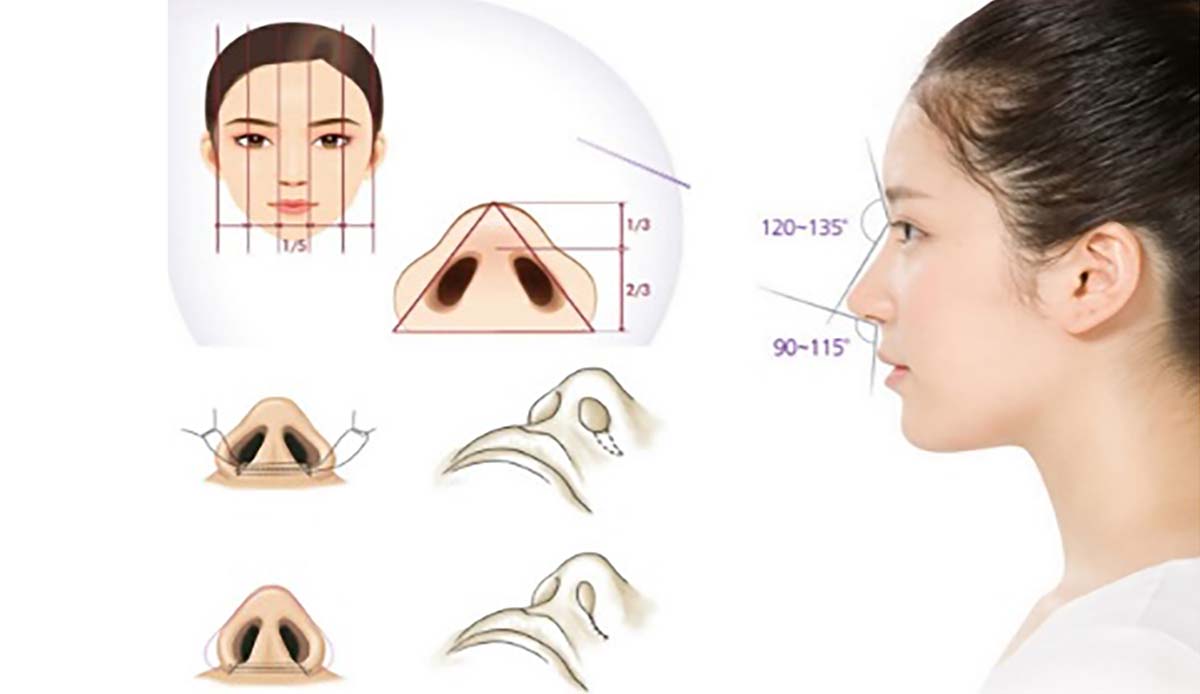 Cắt cánh mũi là giải pháp thẩm mỹ dành cho những người có những khuyết điểm về cánh mũi trở nên xinh đẹp hơn