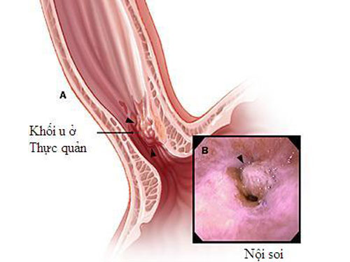 Trào ngược dạ dày thực quản cần được chữa ngay