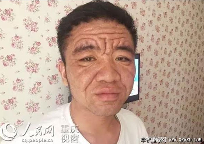 Người đàn ông 30 tuổi có gương mặt như 80