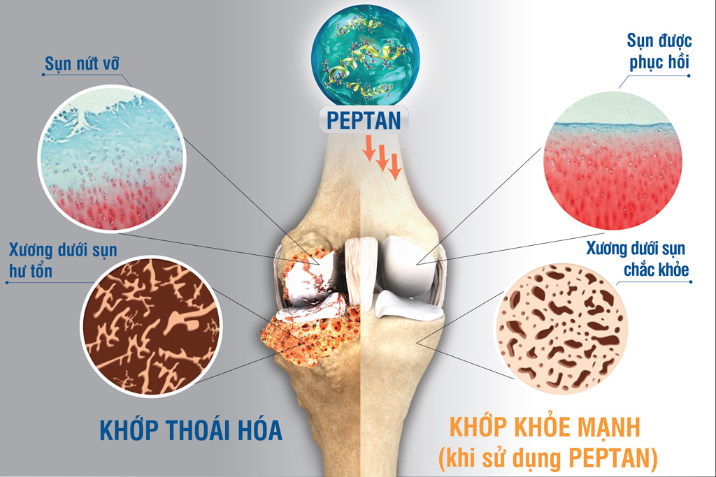 Những khó khăn trong điều trị bệnh xương khớp