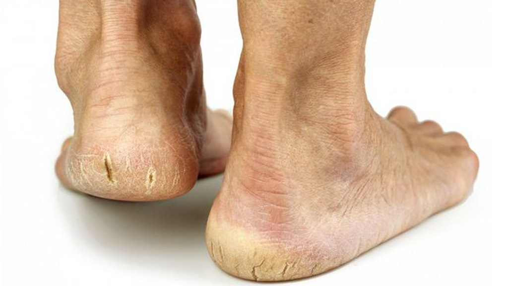 Những nguyên nhân hàng đầu khiến gót chân dễ bị nứt nẻ, bạn đã biết chưa?