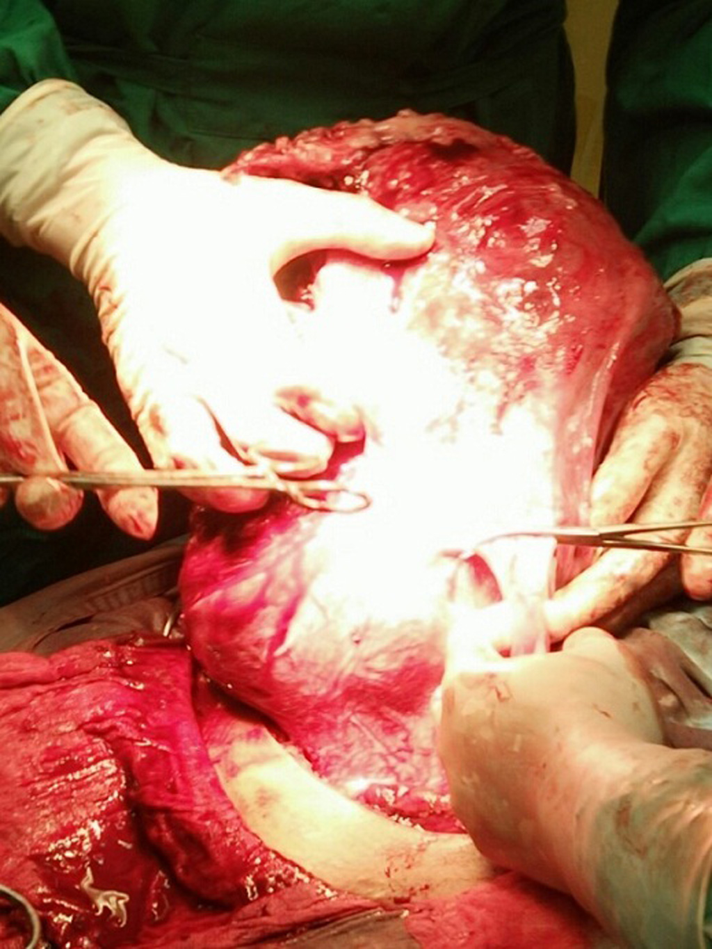 Mổ bắt thai nhi và cắt u xơ nặng 5,9kg 3