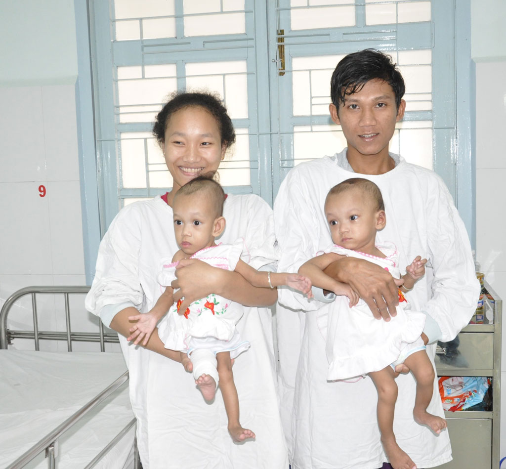 437 ngày nằm trong bệnh viện của 2 bé song sinh dính nhau 1