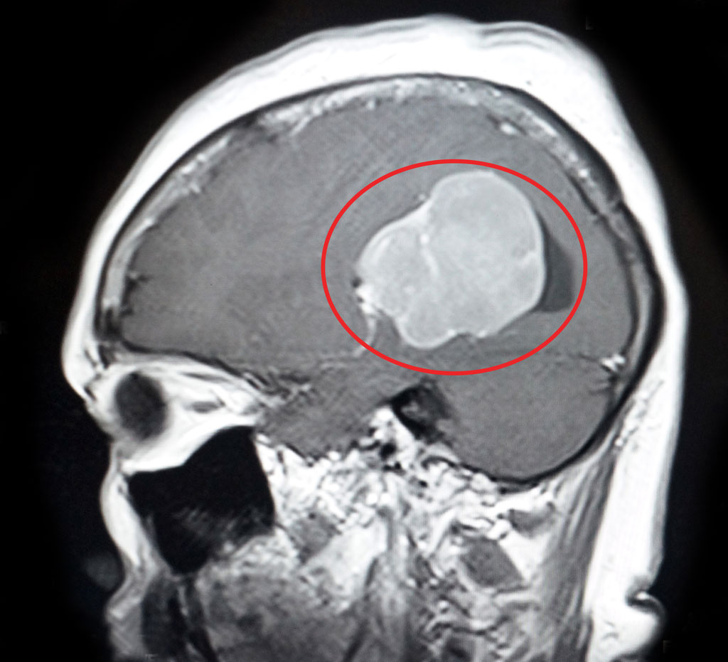 Bệnh nhân có khối u trong não to như quả trứng gà1